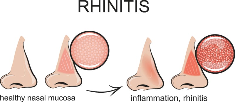 Vaso Rhinitis RhinAer for Chronic Rhinitis Tampa FL, Nasal & Sinus Services