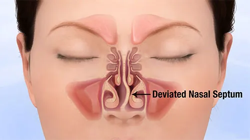 deviated-septum