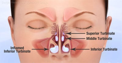 turbinates