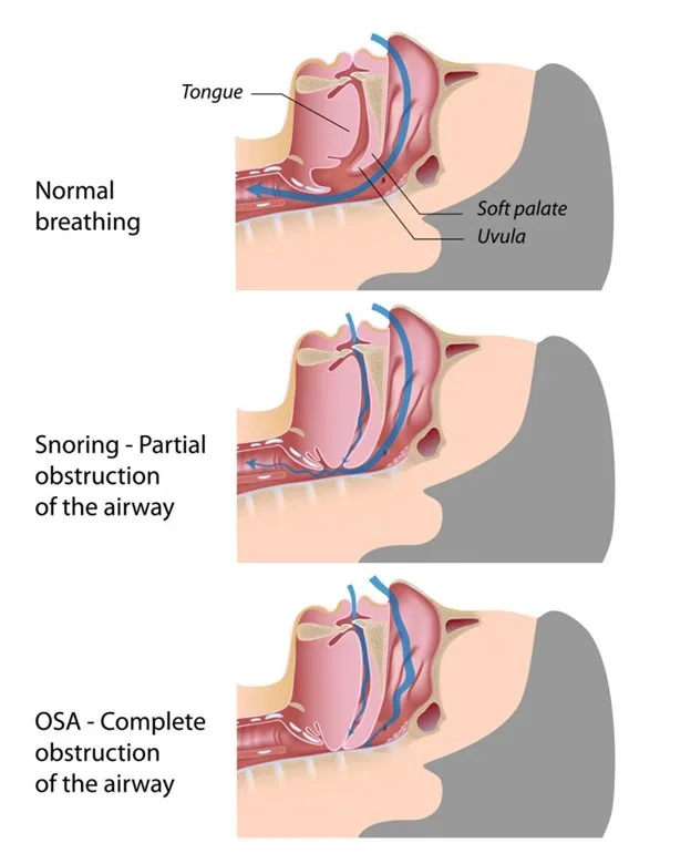 Snoring 1