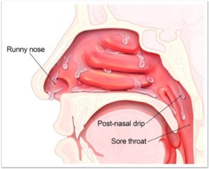 post-nasal drip
