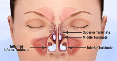 Nasal Turbinates Anatomy